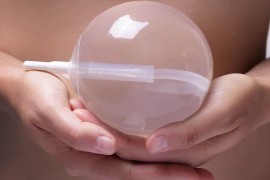 Gastric Balloon
