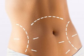 Tummy Tuck